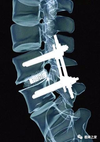 脊柱外科植入物-胸腰椎固定系统Spine Thoracic and Lumbar fixation System