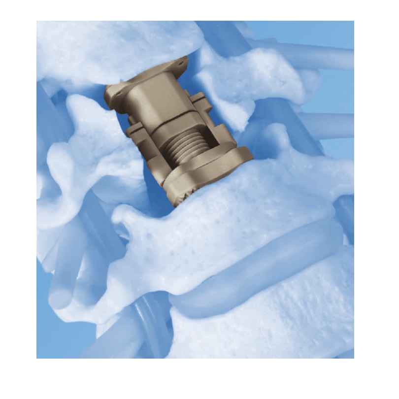 伸展型人工椎体ECD-Expandable Corpectomy Device