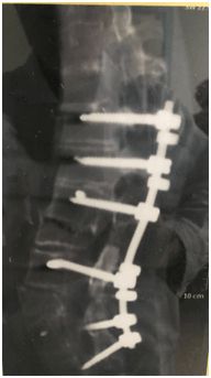 脊柱内固定系统组件-钴铬钼棒Polaris Spinal System