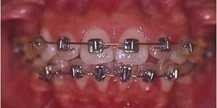 金属托槽Metal bracket