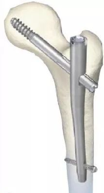 膝关节融合髓内钉T2 Knee Arthrodesis Nail