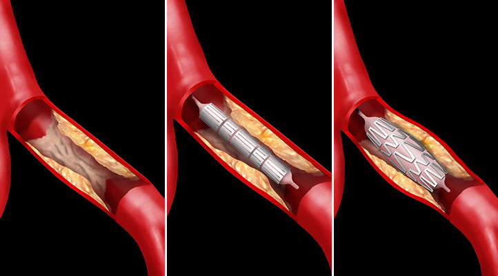 支架推送导管Fusion Pushing Catheter