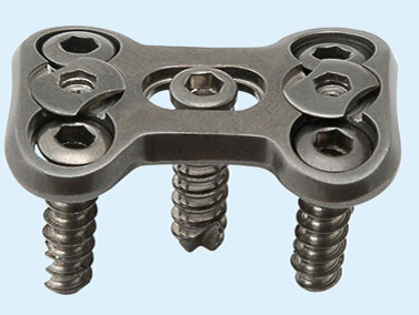 悬吊钛板Rigidloop System