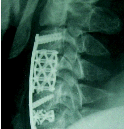 钛网融合器Pyramesh Implant System