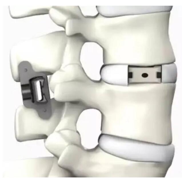 棘突固定板Interspinous Fixation System